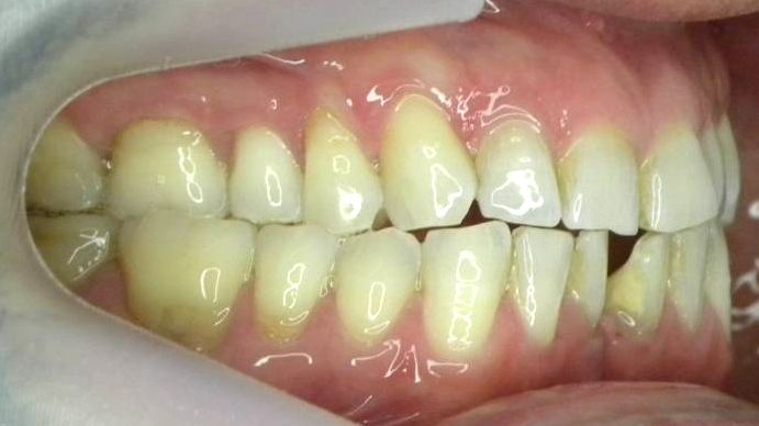 Lateral Derecha