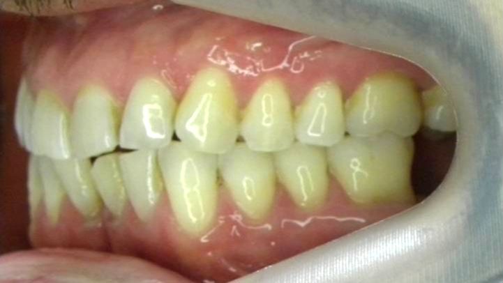 Lateral Izquierda