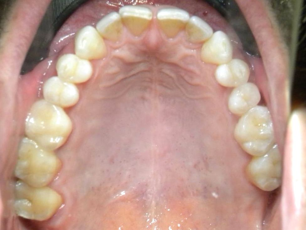 Oclusal Superior