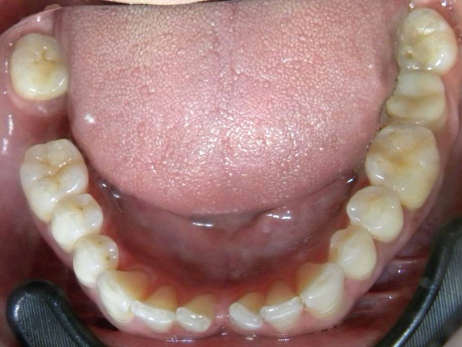 Oclusal Inferior