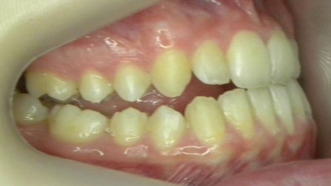 Lateral Derecha