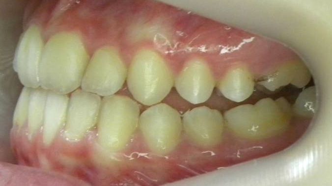 Lateral Izquierda