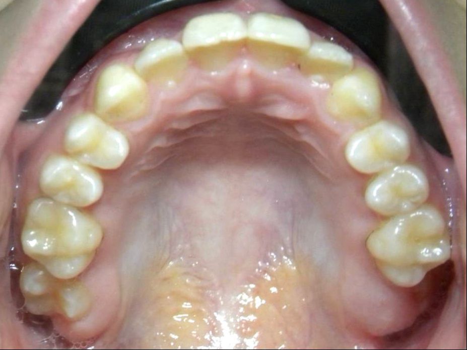 Oclusal Superior