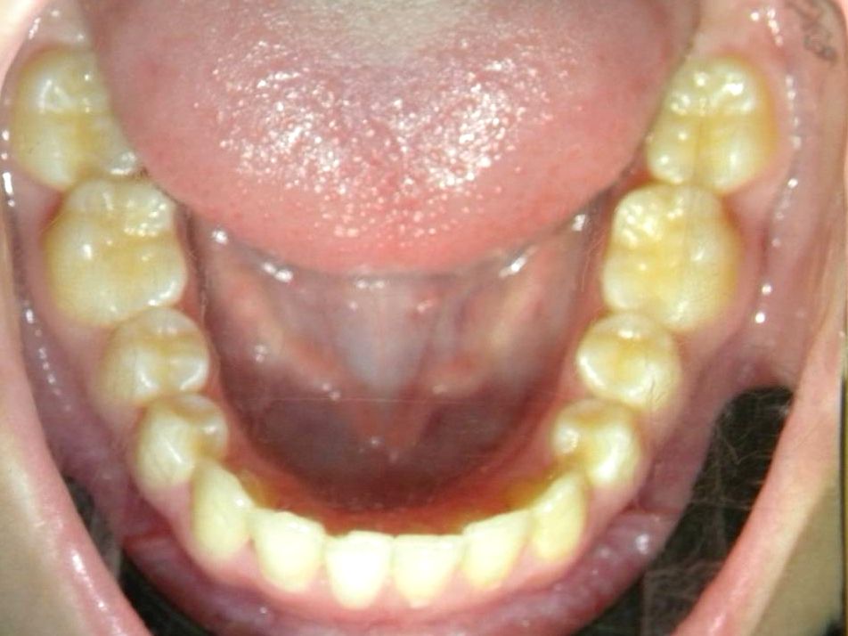 Oclusal Inferior