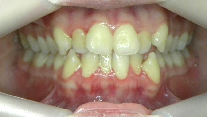 Frontal (Oclusión)