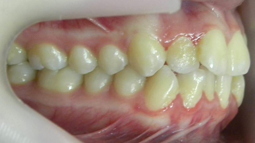 Lateral Derecha