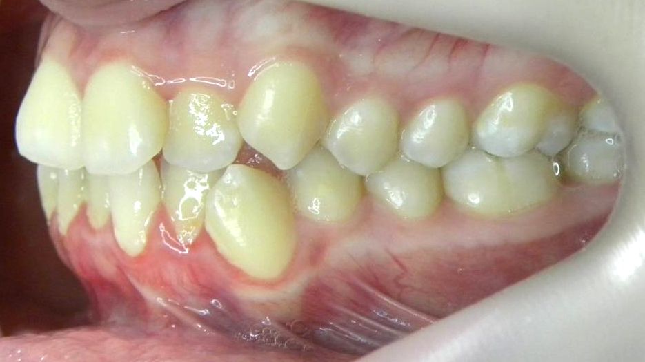 Lateral Izquierda