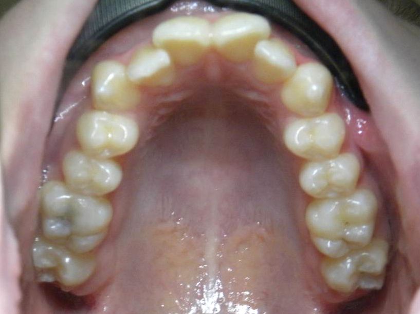 Oclusal Superior
