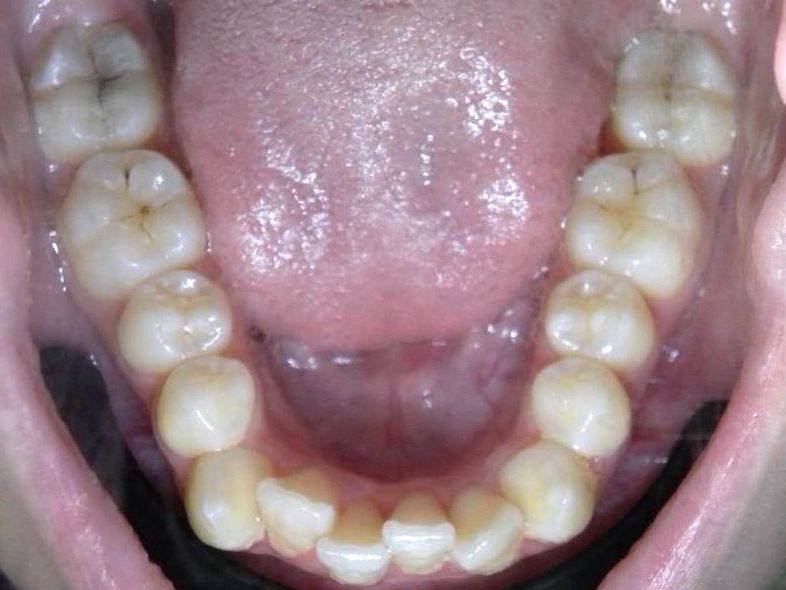 Oclusal Inferior