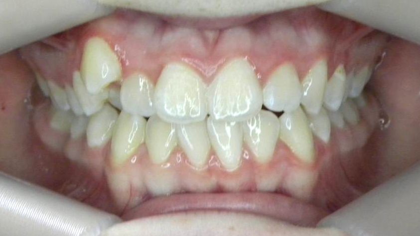 Frontal (Oclusión)