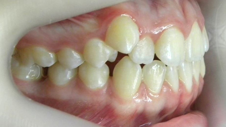 Lateral Derecha