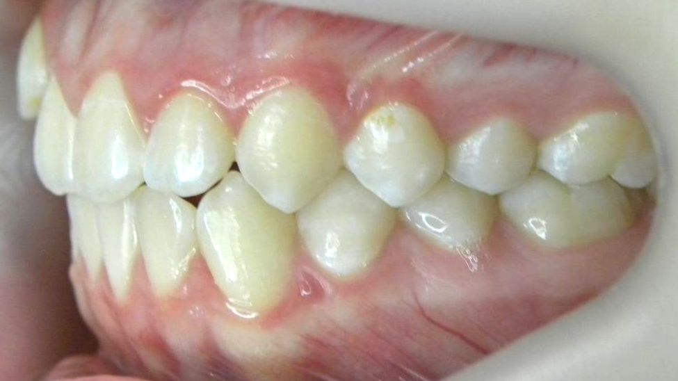 Lateral Izquierda
