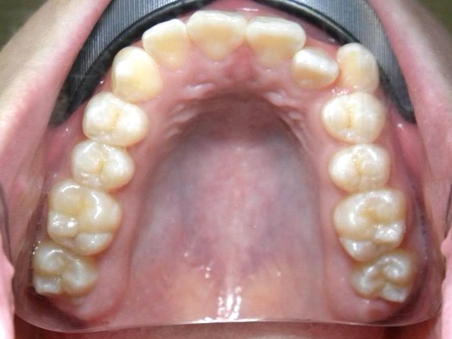 Oclusal Superior