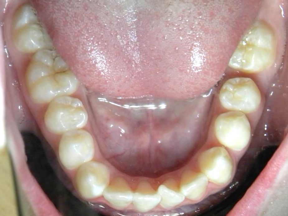 Oclusal Inferior