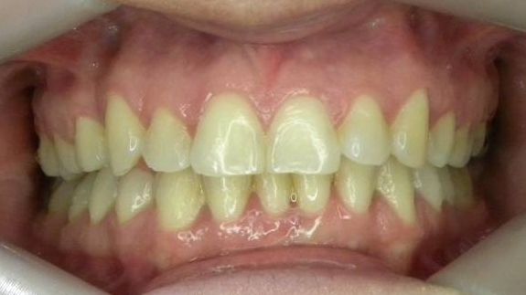 Frontal (Oclusión)