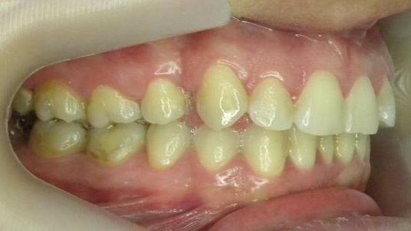 Lateral Derecha