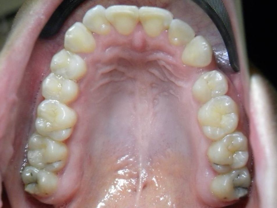 Oclusal Superior