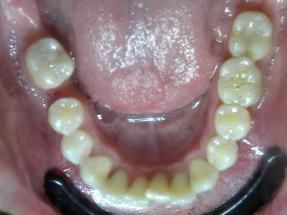 Oclusal Inferior