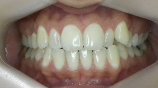 Frontal (Oclusión)