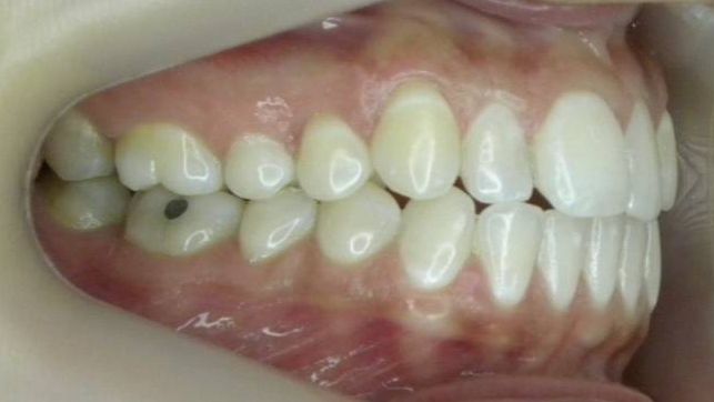 Lateral Derecha