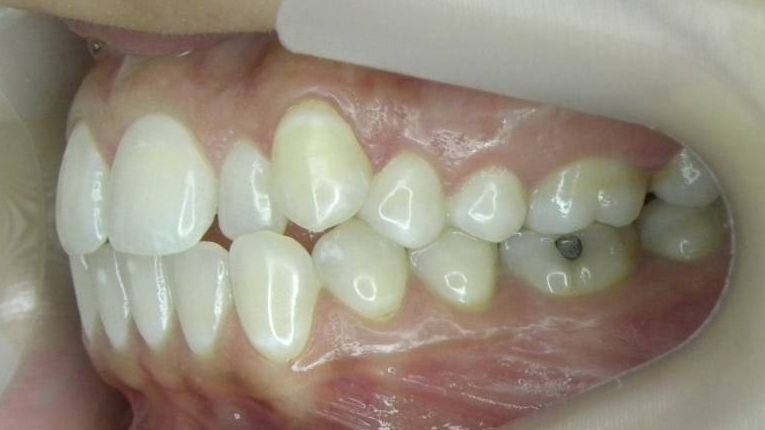 Lateral Izquierda
