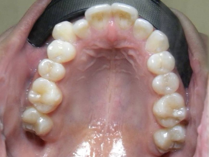 Oclusal Superior