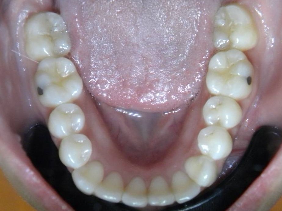 Oclusal Inferior