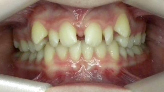 Frontal (Oclusión)