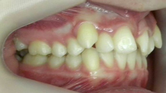 Lateral Derecha