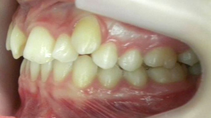 Lateral Izquierda