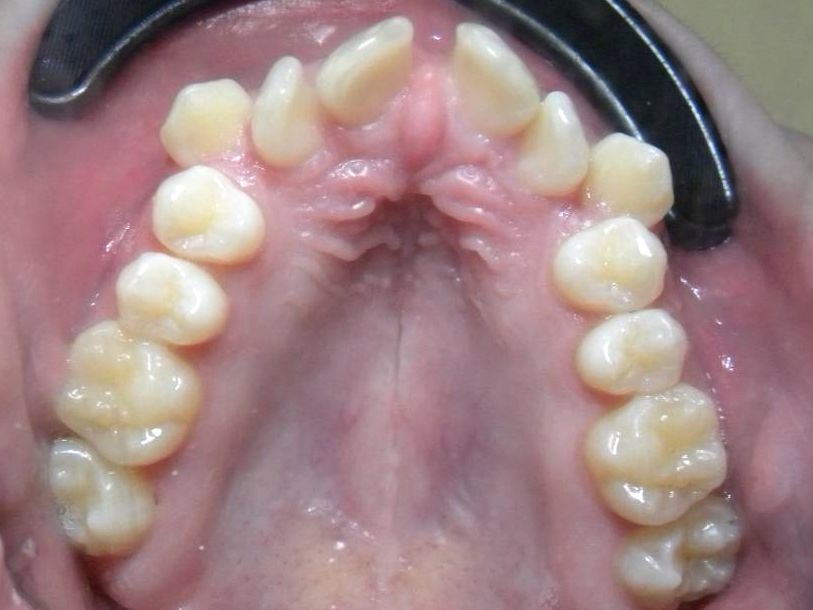 Oclusal Superior