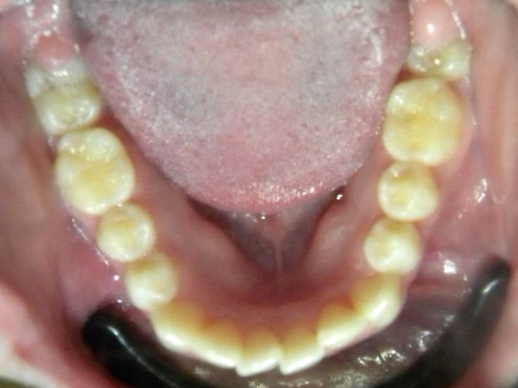 Oclusal Inferior