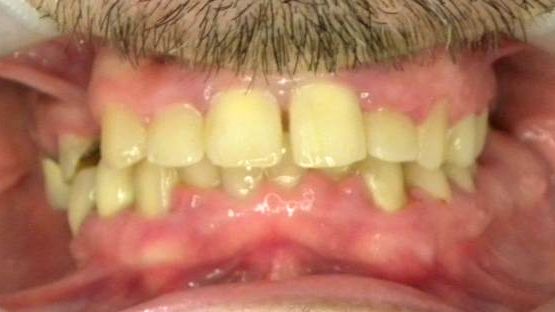 Frontal (Oclusión)