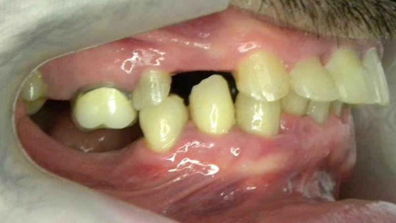 Lateral Derecha