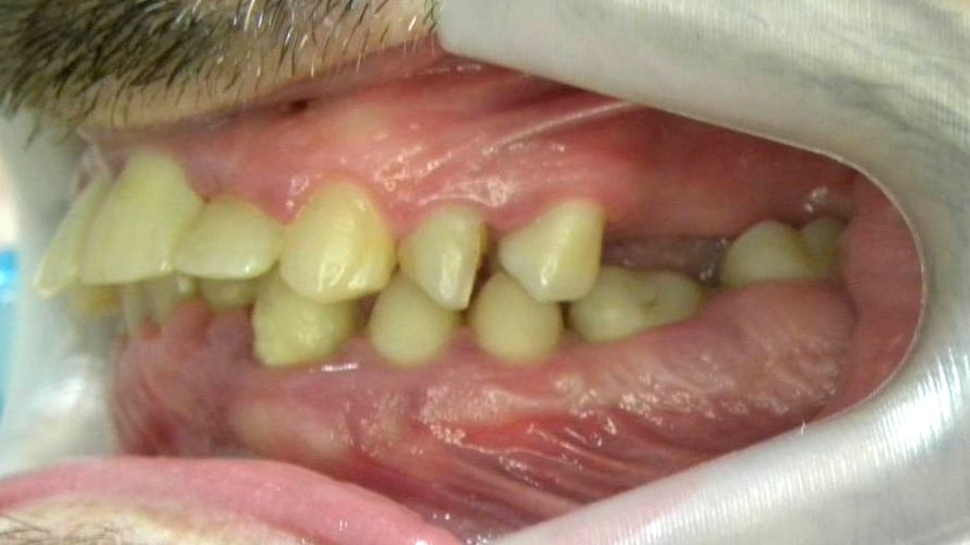 Lateral Izquierda