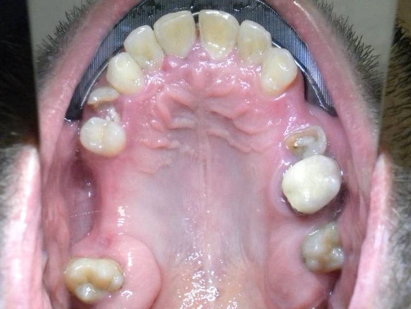 Oclusal Superior