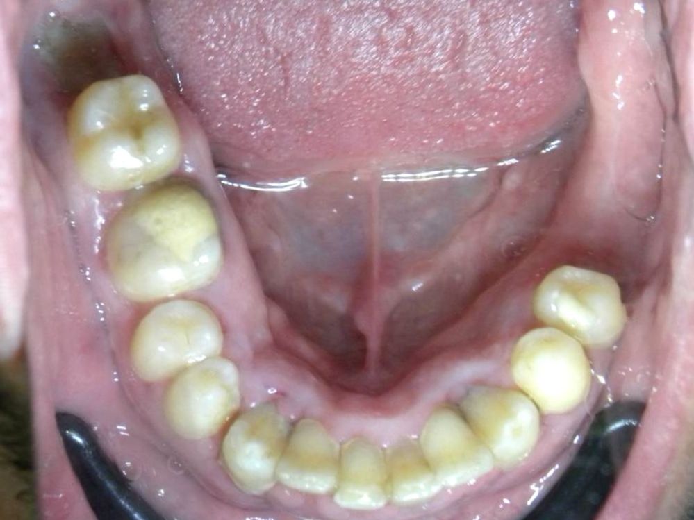 Oclusal Inferior