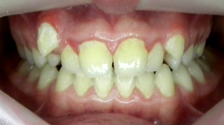 Frontal (Oclusión)