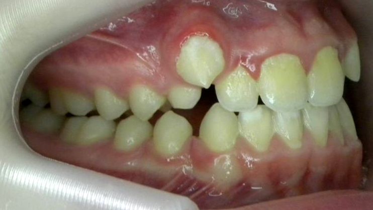Lateral Derecha