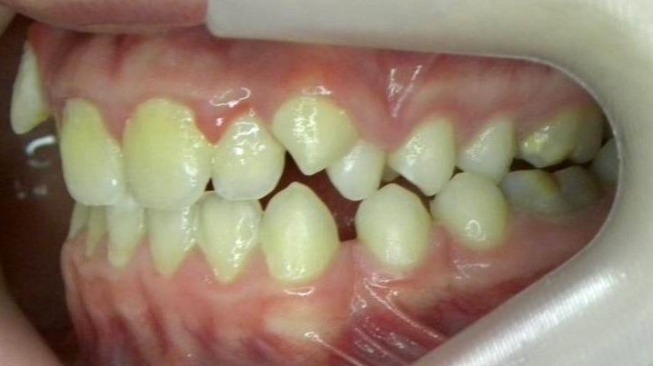Lateral Izquierda