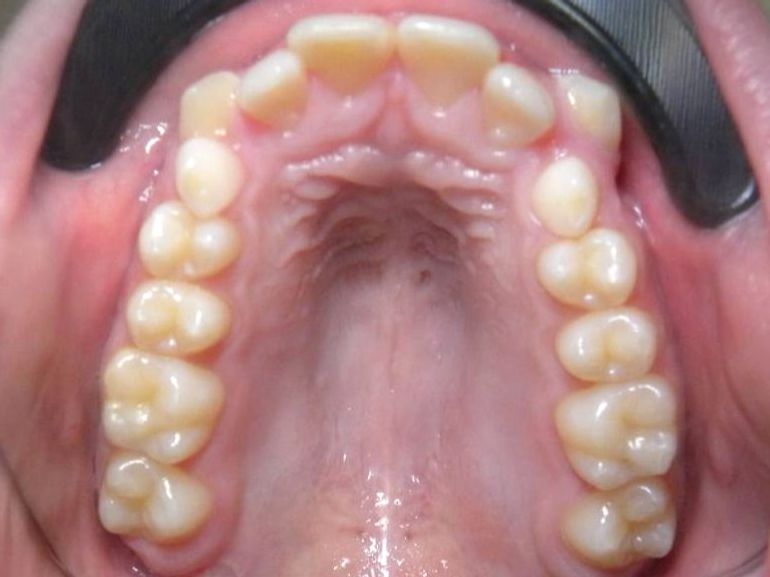 Oclusal Superior