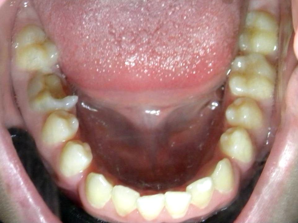 Oclusal Inferior