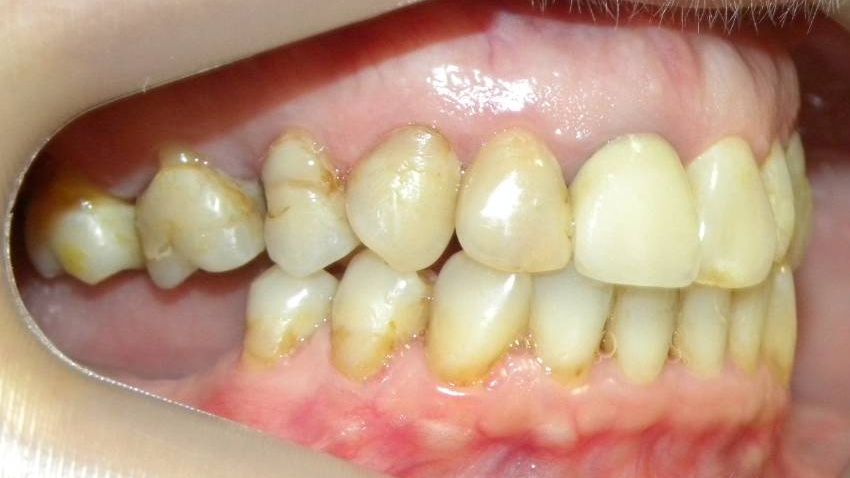 Lateral Derecha