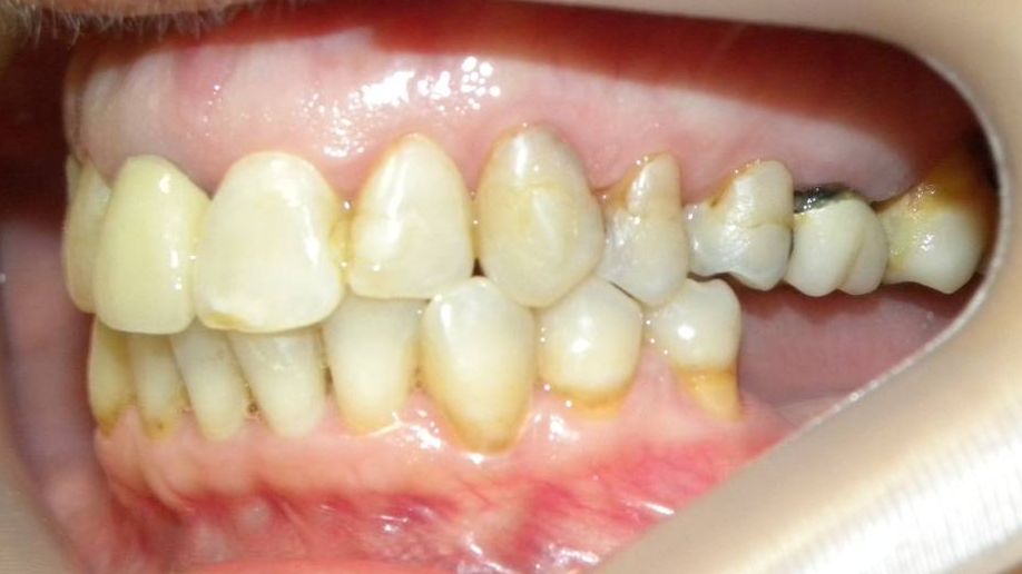Lateral Izquierda