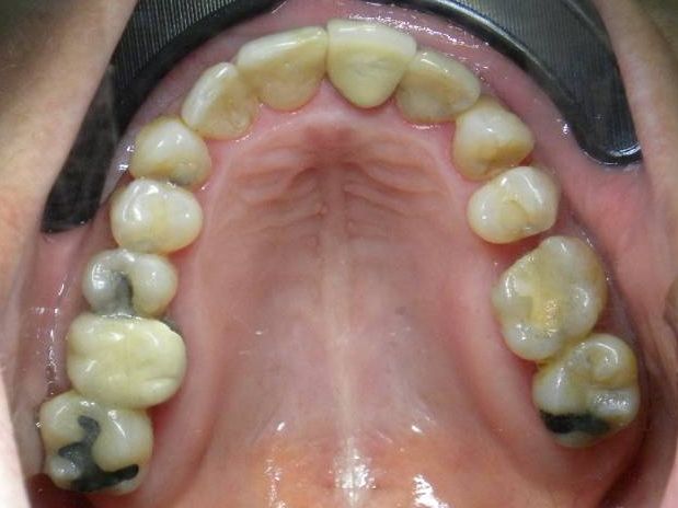 Oclusal Superior