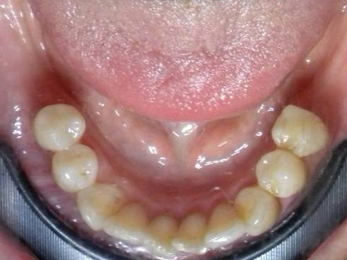Oclusal Inferior