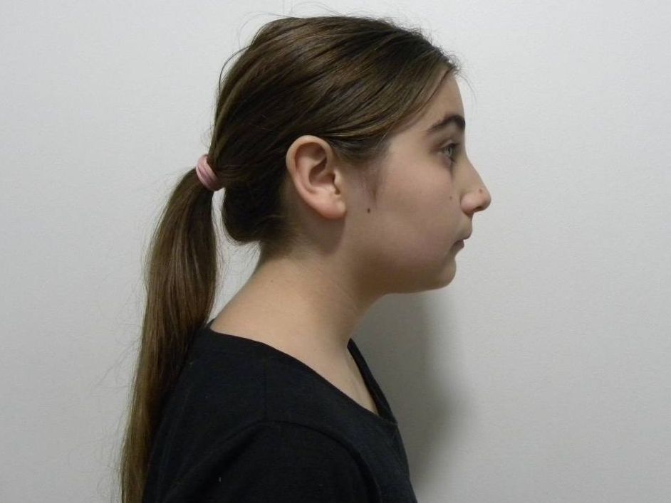 Lateral estricta derecha