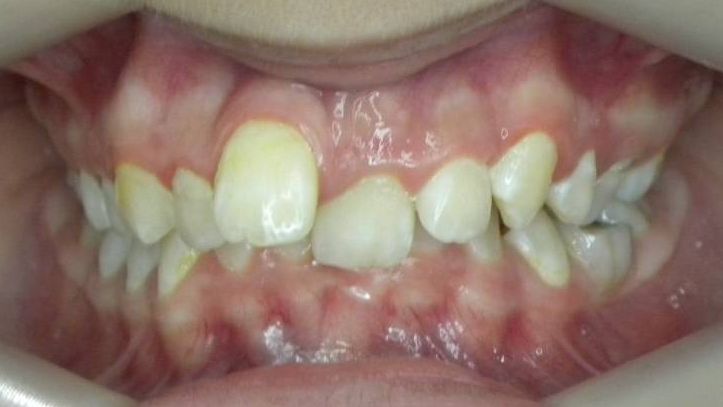 Frontal (Oclusión)