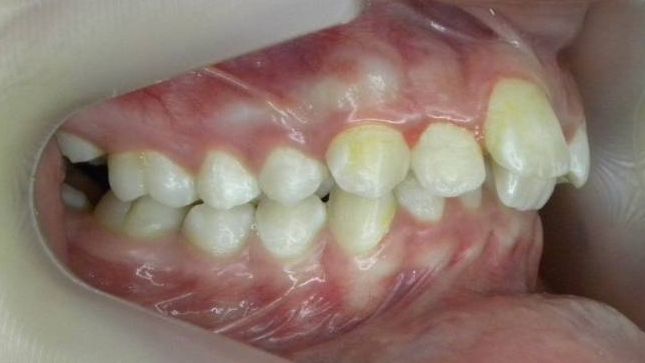 Lateral Derecha