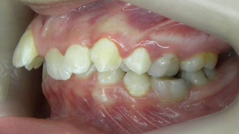 Lateral Izquierda